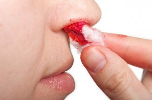 Как бързо и лесно да спрем кървенето от носа?